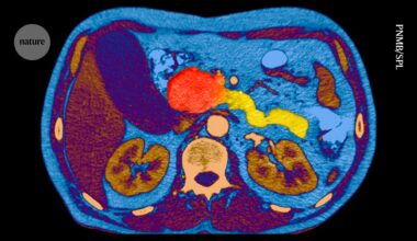 Landmark cancer trial shows success against ‘undruggable’ cancer — raising hopes for future treatments