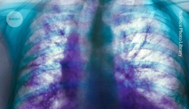 This mysterious lung disease affects millions of people — but a drug tested in mice shows promise