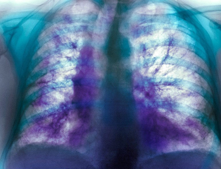 Coloured X-ray of the chest of a man with idiopathic pulmonary fibrosis, showing clear scaring of the alveoli.