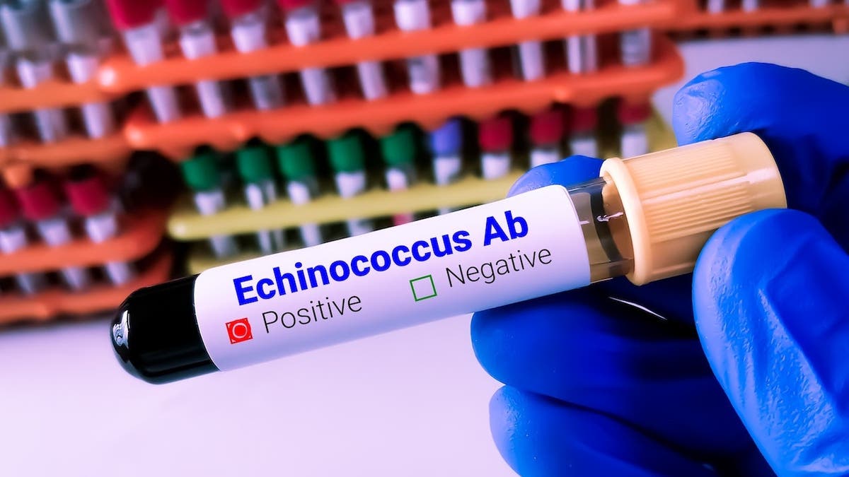 Scientist holding blood sample for Echinococcus antibody test.