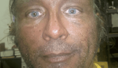 Man who's injected Melanotan II for years shares before and after photos