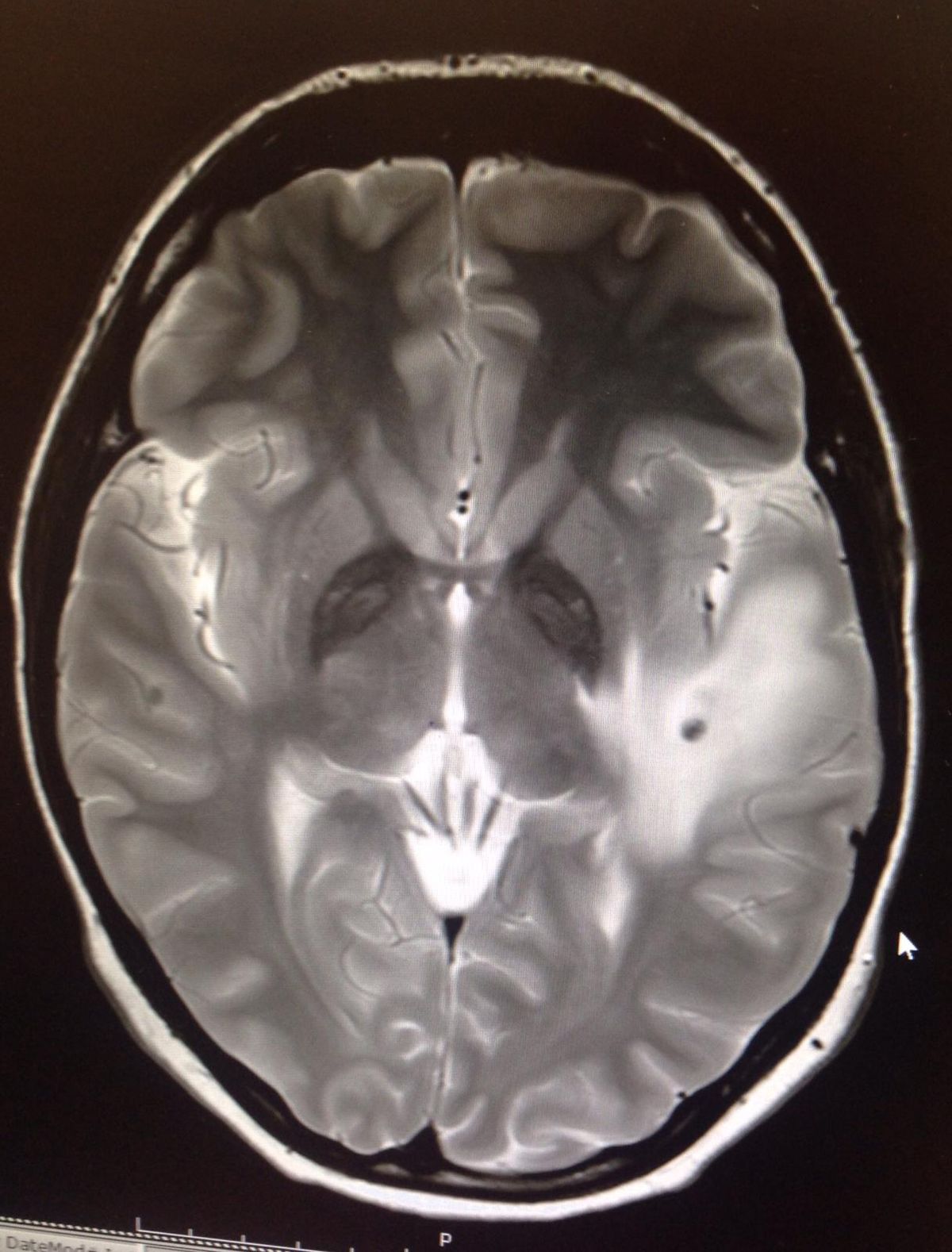 Lowri's brain scan, showing some of the parasites
