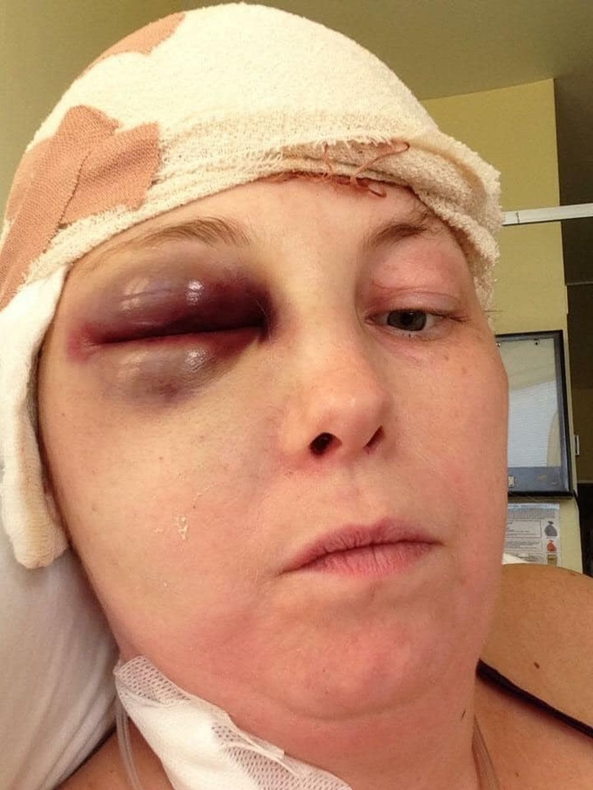 Trish after surgery