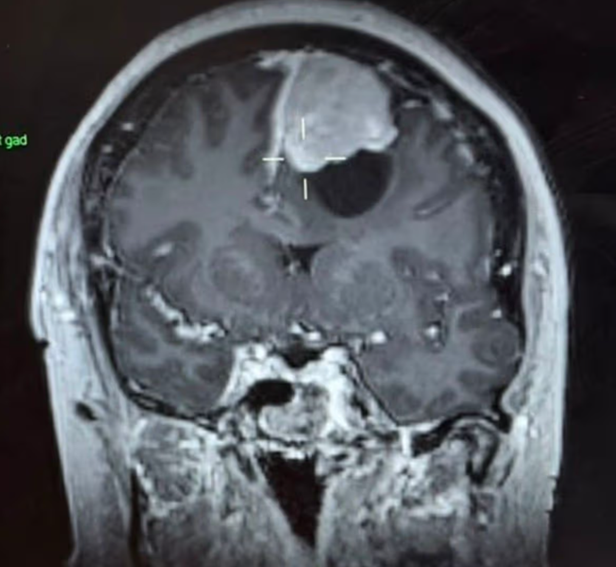 The tangerine-sized tumour, and cyst, in Kirsty's skull