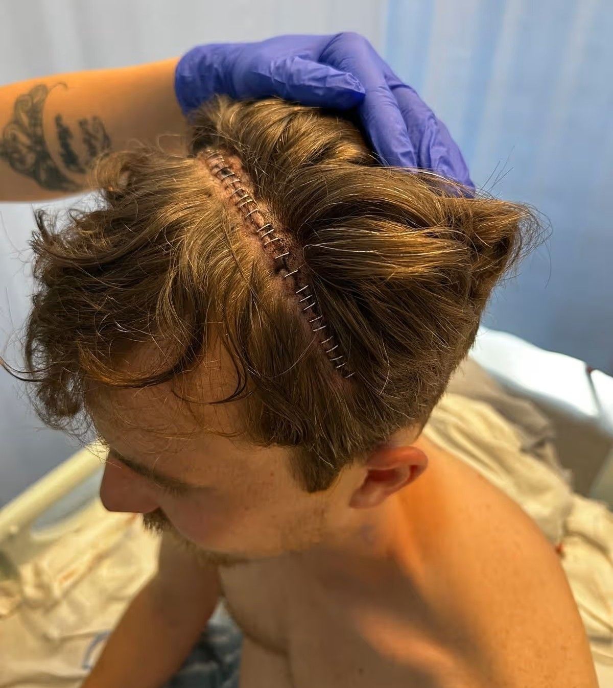 Elliot underwent open brain surgery