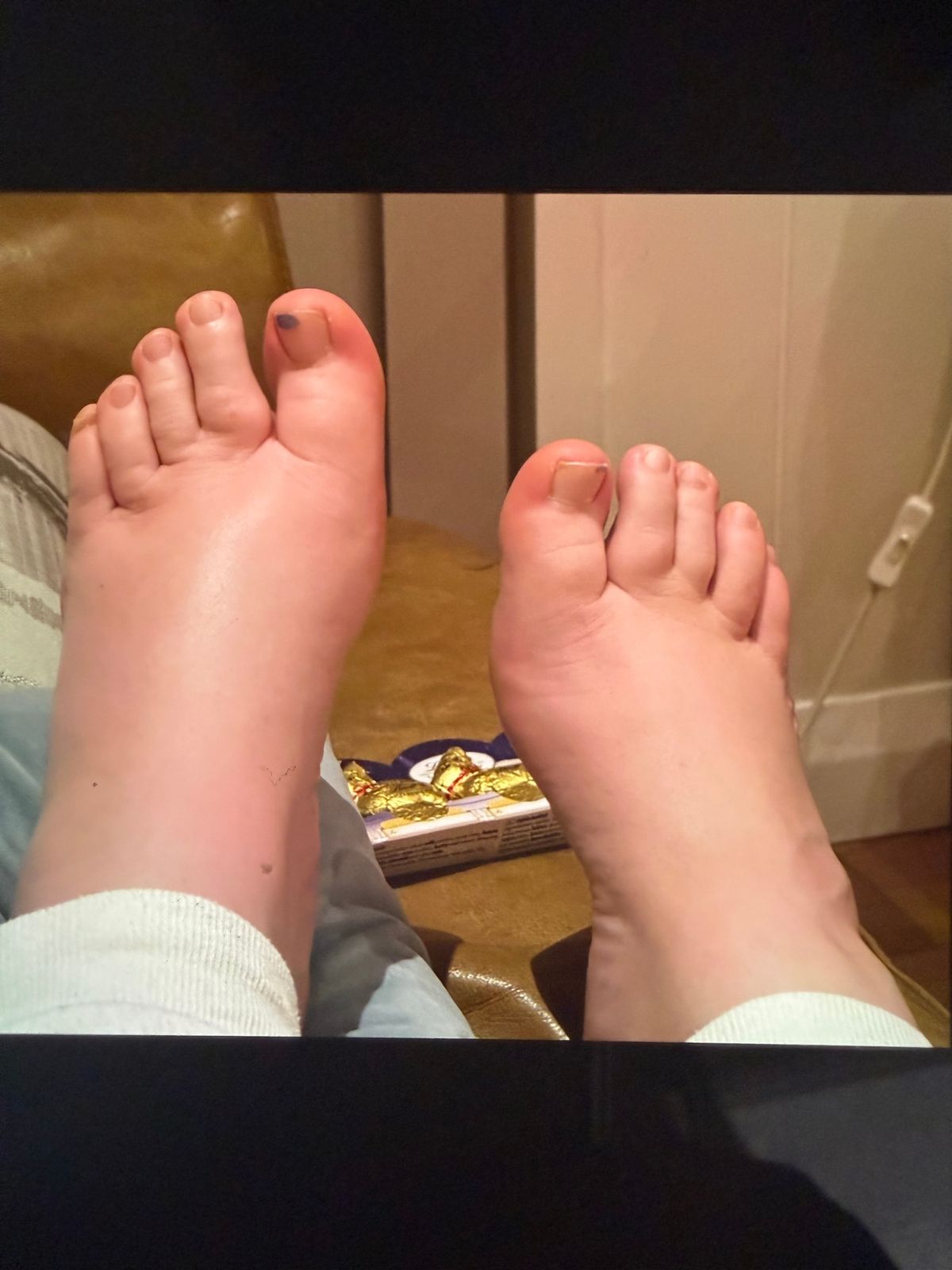 A photo of Elisha's swollen feet