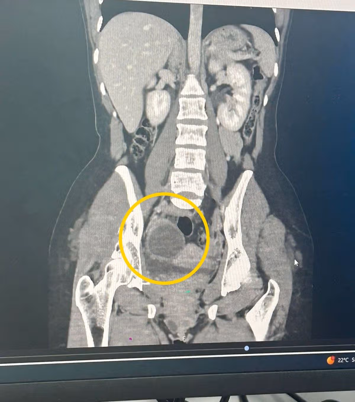 An x-ray pinpointing Cydnie's tumours