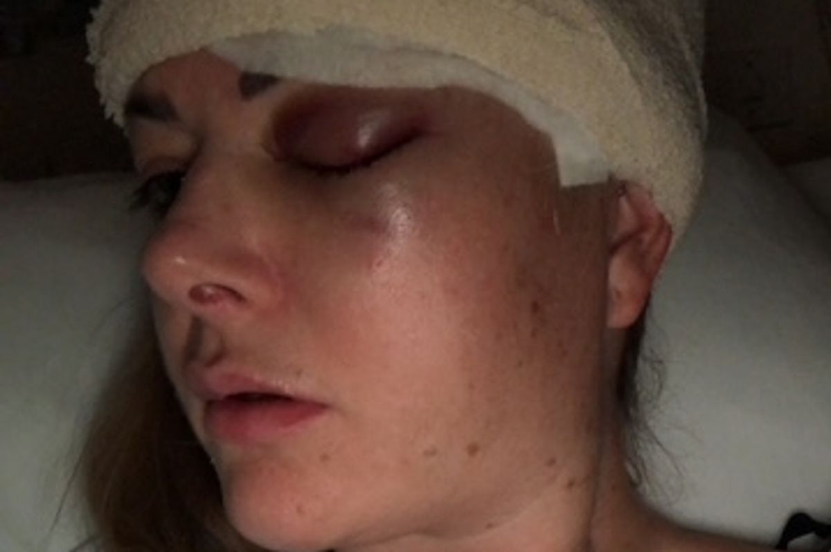 Tammy Croston was left without the use of one of her eyes after surgery to remove her tumour went wrong