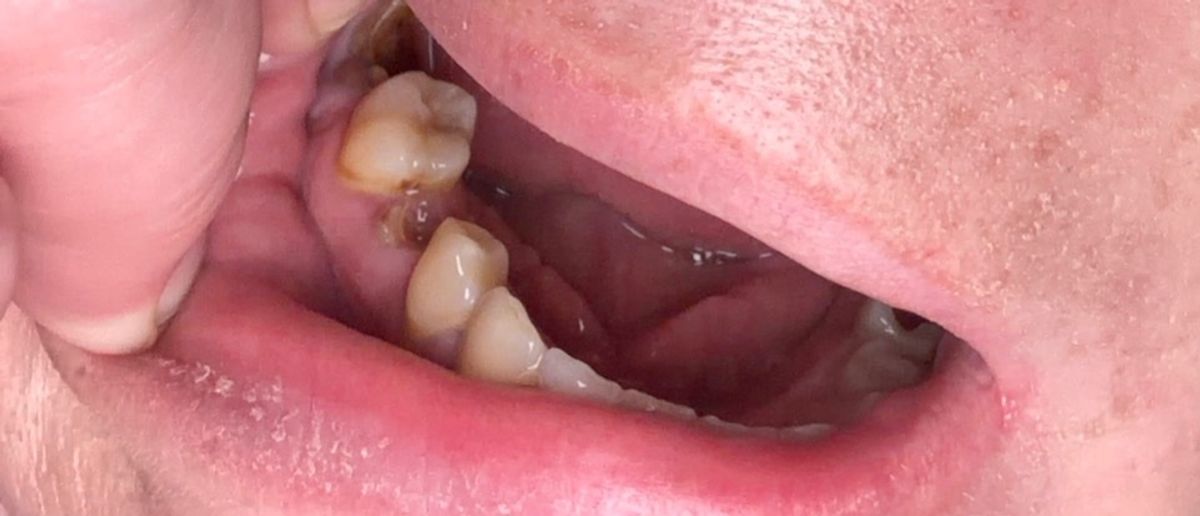 A photo of Elisha's teeth