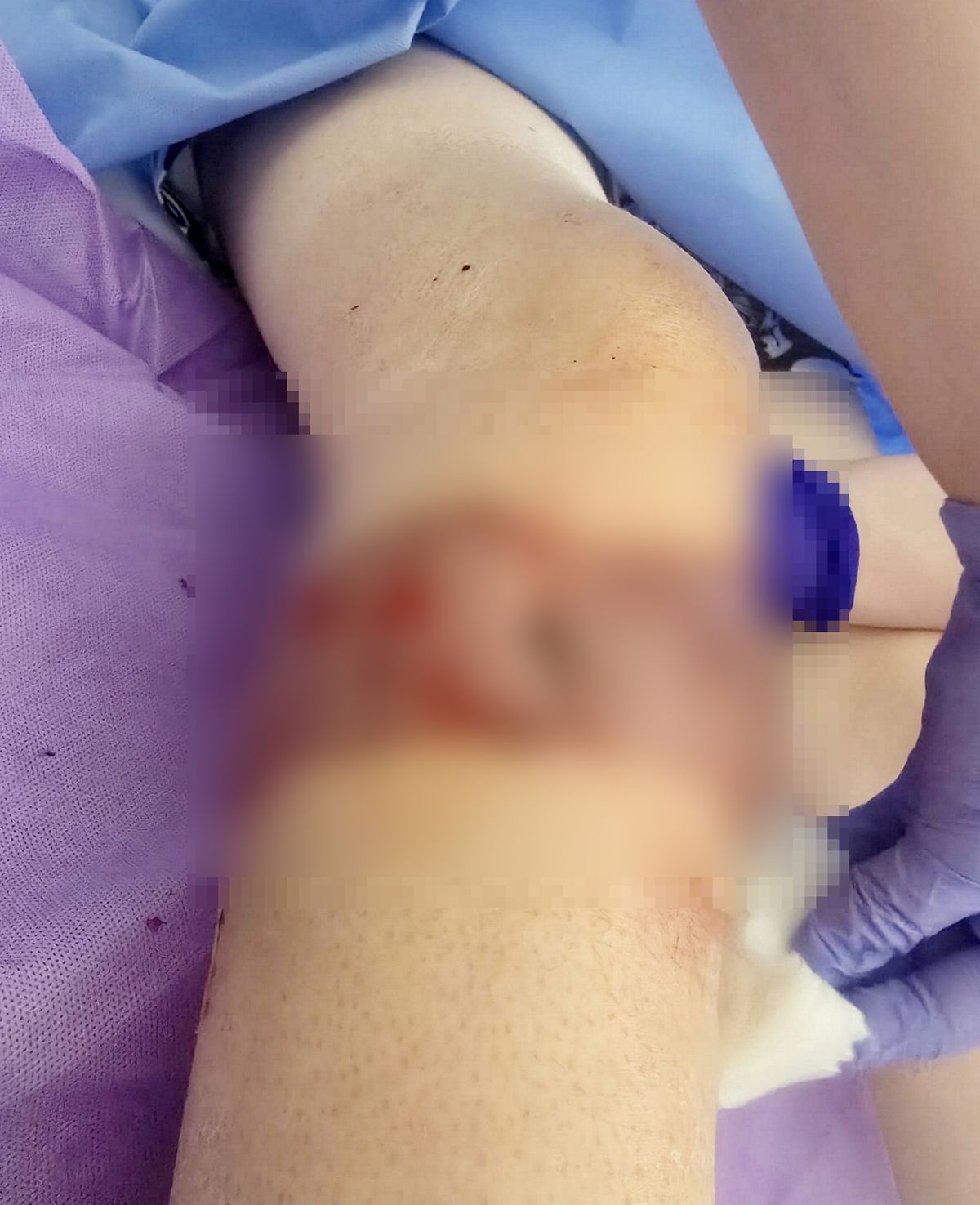 Jacob Butler's leg following skin graft