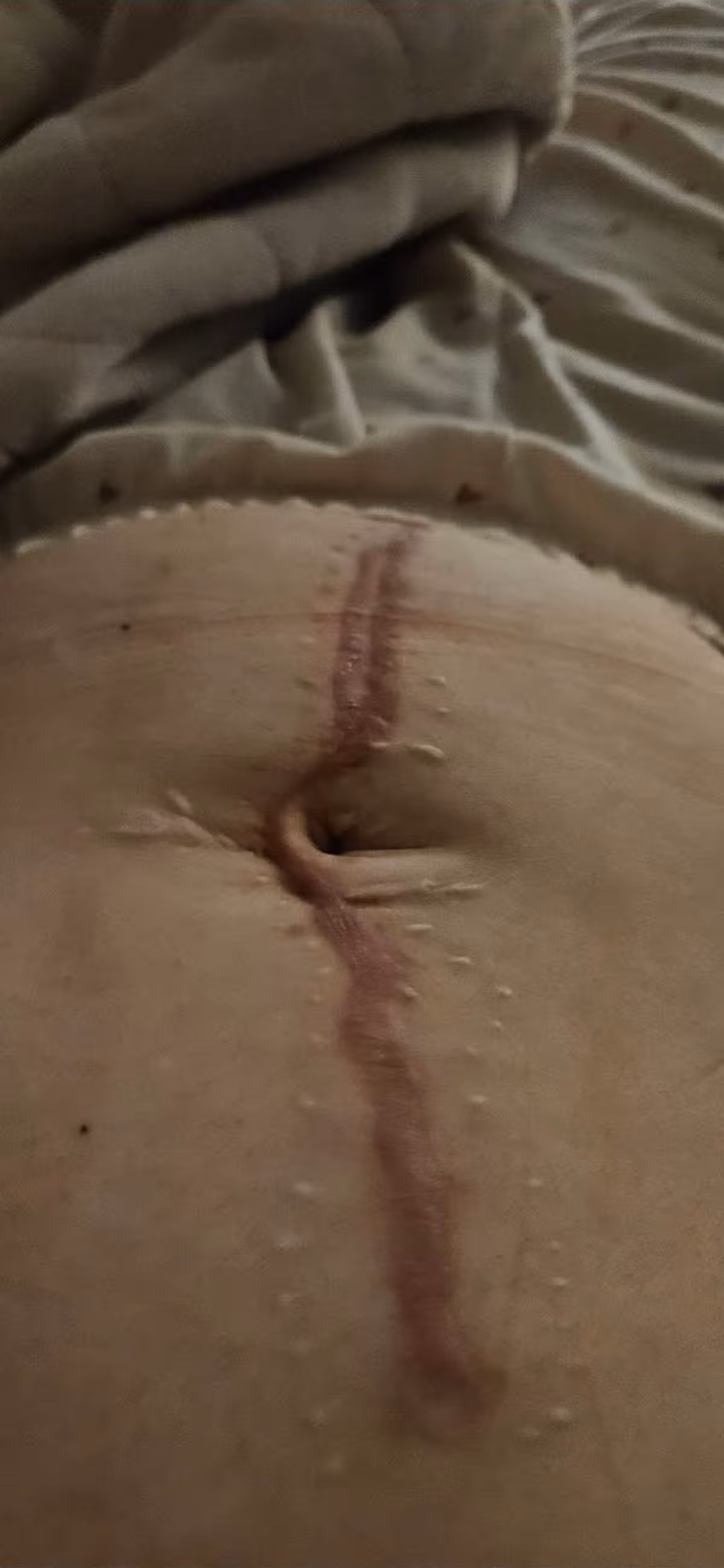 A photo of the scar where Chelsea had her operation
