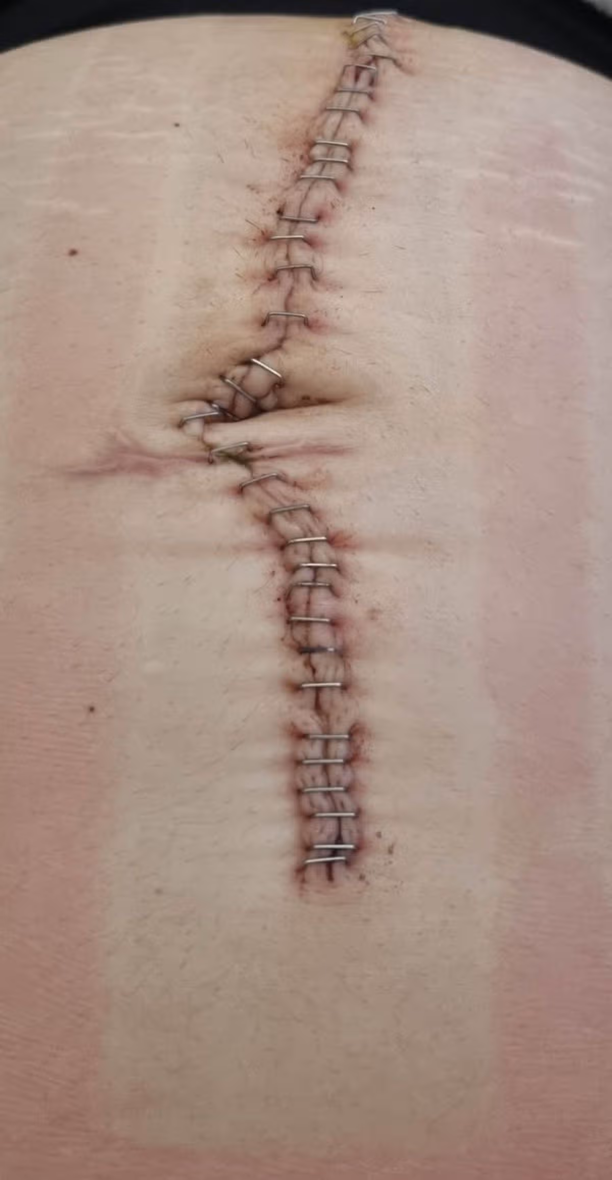 A photo of Chelsea's scar