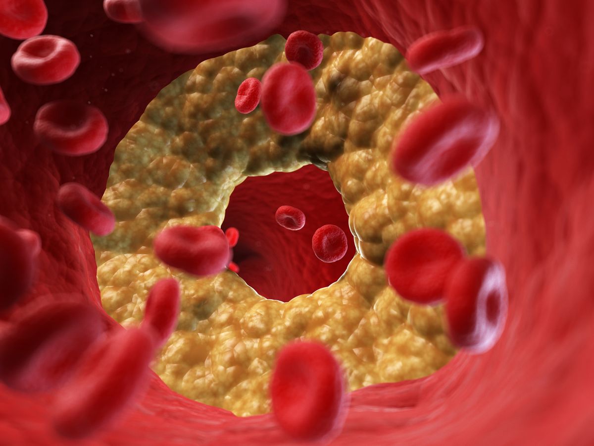 Illustration of a blocked artery.
