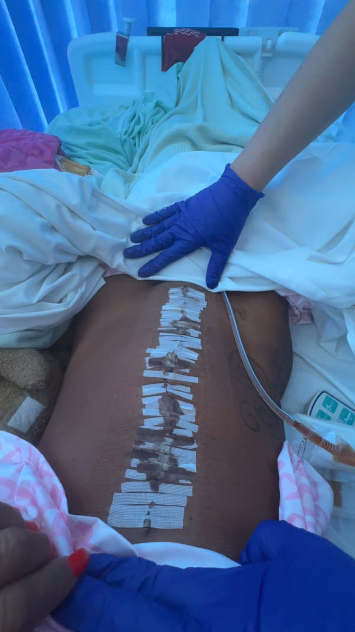 Cydnie's abdomen stitched up after surgery