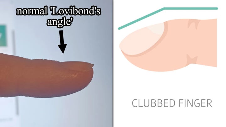 normal Loviband's angle vs clubbed nail