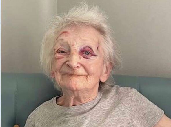 Elizabeth McBride with bruises on eye and face Elizabeth McBride with bruises on eye and face