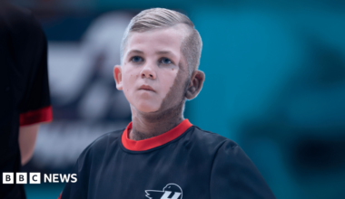 A teenage boy wearing a sports kit looks up. He has blonde hair, blue eyes and a birthmark across one side of his face and neck.