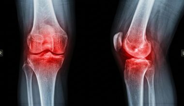 Arthritic Knee Joint Pain Inflammation