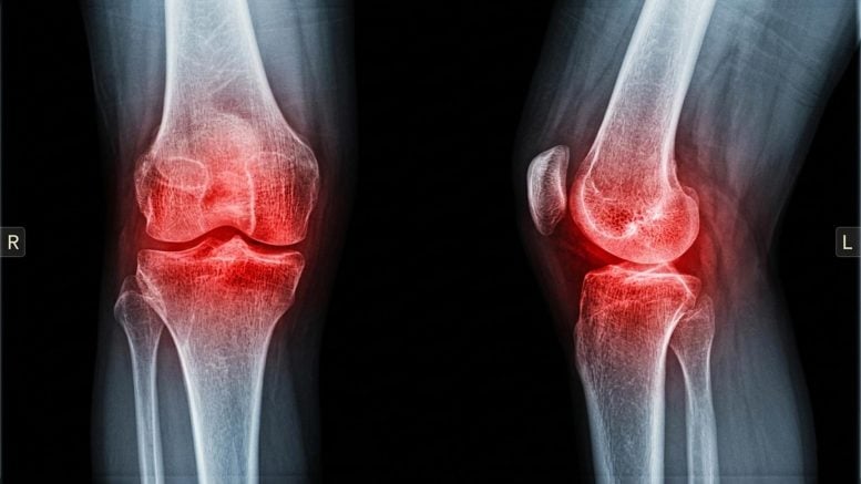 Arthritic Knee Joint Pain Inflammation