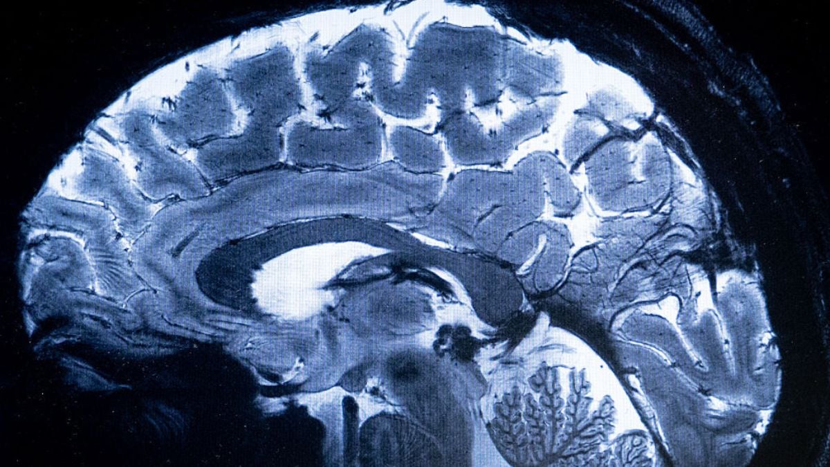 Brain Dramatically Remodels Its Cellular Composition, Starting in Midlife : ScienceAlert