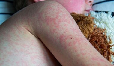 Health bosses urge people to get MMR vaccinations as Kent and Medway see a rise in measles