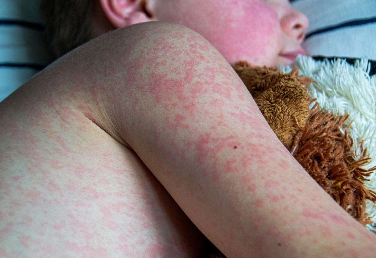 Health bosses urge people to get MMR vaccinations as Kent and Medway see a rise in measles