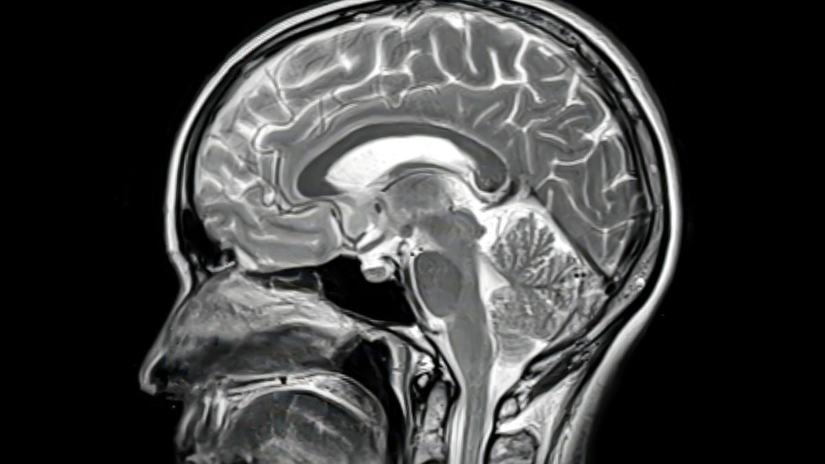 Rare Autopsy Finds Alzheimer's Drugs Only Work in Some Parts of The Brain : ScienceAlert