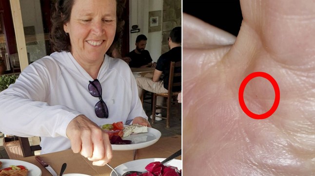 Laura Horton sitting at a table with food (Left) and the small bite marks on Laura's hand after she held the bat (Right)