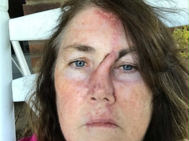 Picture from Kennedy News & Media (PICTURED: LISA CHRISTIAN, 61, AFTER HER FIRST SURGERY.) A pale mum who 'tanned to feel pretty' needed such extreme facial reconstruction for a cancerous 'dot' on her nose that she hid indoors for fear of scaring kids. Lisa Christian, from Texas in the US, says she spent her younger years lying in the sun to try and tan her 'pale' skin to feel pretty. At prom she remembers feeling like a 'ghost' standing next to her tanned sisters due to her porcelain-like complexion. DISCLAIMER: While Kennedy News and Media uses its best endeavours to establish the copyright and authenticity of all pictures supplied, it accepts no liability for any damage, loss or legal action caused by the use of images supplied and the publication of images is solely at your discretion. SEE KENNEDY NEWS COPY - 0161 697 4266