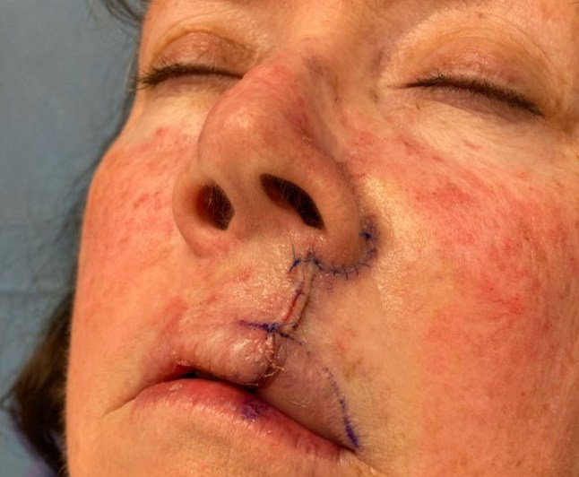 Picture from Kennedy News & Media (PICTURED: LISA CHRISTIAN, 61, ALSO HAD CANCER REMOVED FROM A SPOT ABOVE HER LIP.) A pale mum who 'tanned to feel pretty' needed such extreme facial reconstruction for a cancerous 'dot' on her nose that she hid indoors for fear of scaring kids. Lisa Christian, from Texas in the US, says she spent her younger years lying in the sun to try and tan her 'pale' skin to feel pretty. At prom she remembers feeling like a 'ghost' standing next to her tanned sisters due to her porcelain-like complexion. DISCLAIMER: While Kennedy News and Media uses its best endeavours to establish the copyright and authenticity of all pictures supplied, it accepts no liability for any damage, loss or legal action caused by the use of images supplied and the publication of images is solely at your discretion. SEE KENNEDY NEWS COPY - 0161 697 4266