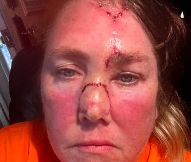 Picture from Kennedy News & Media (PICTURED: LISA CHRISTIAN, 61, HEALING AFTER HER SURGERIES.) A pale mum who 'tanned to feel pretty' needed such extreme facial reconstruction for a cancerous 'dot' on her nose that she hid indoors for fear of scaring kids. Lisa Christian, from Texas in the US, says she spent her younger years lying in the sun to try and tan her 'pale' skin to feel pretty. At prom she remembers feeling like a 'ghost' standing next to her tanned sisters due to her porcelain-like complexion. DISCLAIMER: While Kennedy News and Media uses its best endeavours to establish the copyright and authenticity of all pictures supplied, it accepts no liability for any damage, loss or legal action caused by the use of images supplied and the publication of images is solely at your discretion. SEE KENNEDY NEWS COPY - 0161 697 4266