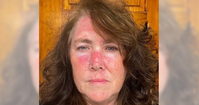 Lisa in a selfie, her nose and forehead is red
