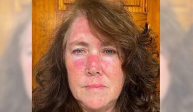 Shocking photos reveal consequences of mum's lifelong tanning obsession