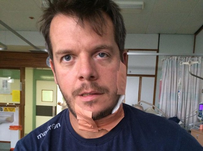 Tim following an operation to remove a tumour on the left side of his face (PA Real Life/collect)