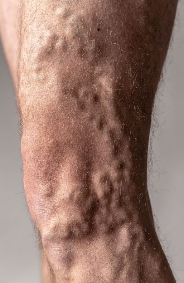 Varioce veins can be painful and unsightly