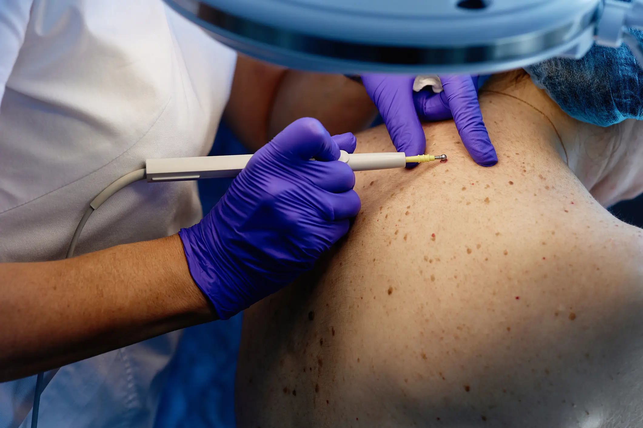 Unregulated and untested, the drug can lead to various complications, including skin cancer (Getty Stock Images)