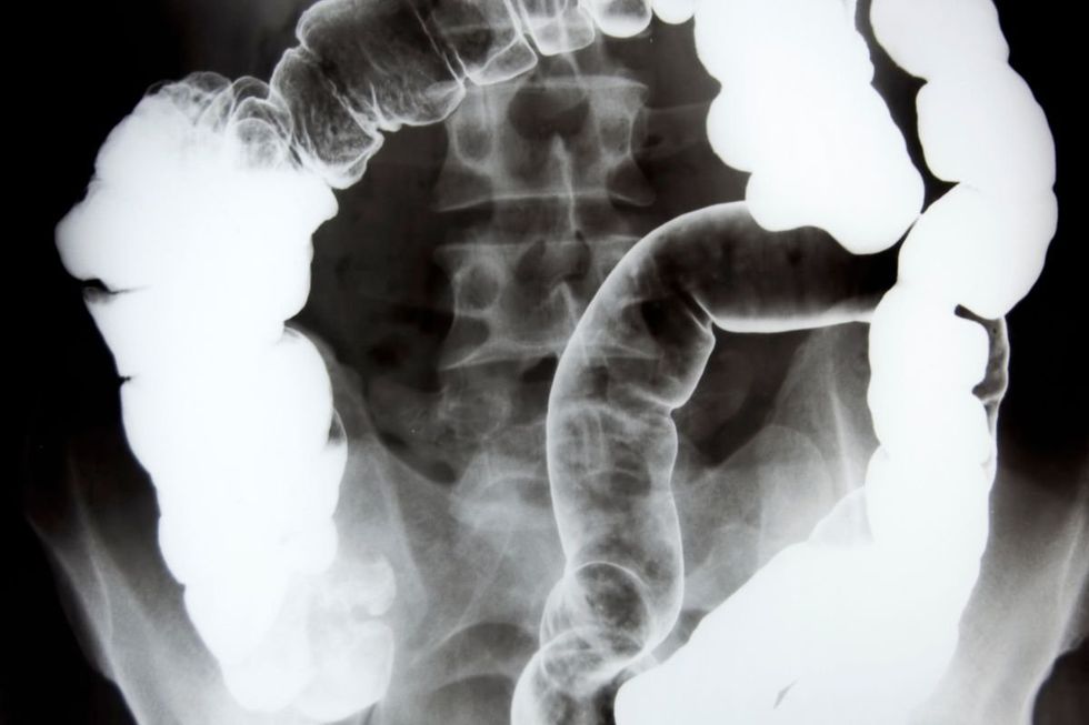 BOWEL SCAN