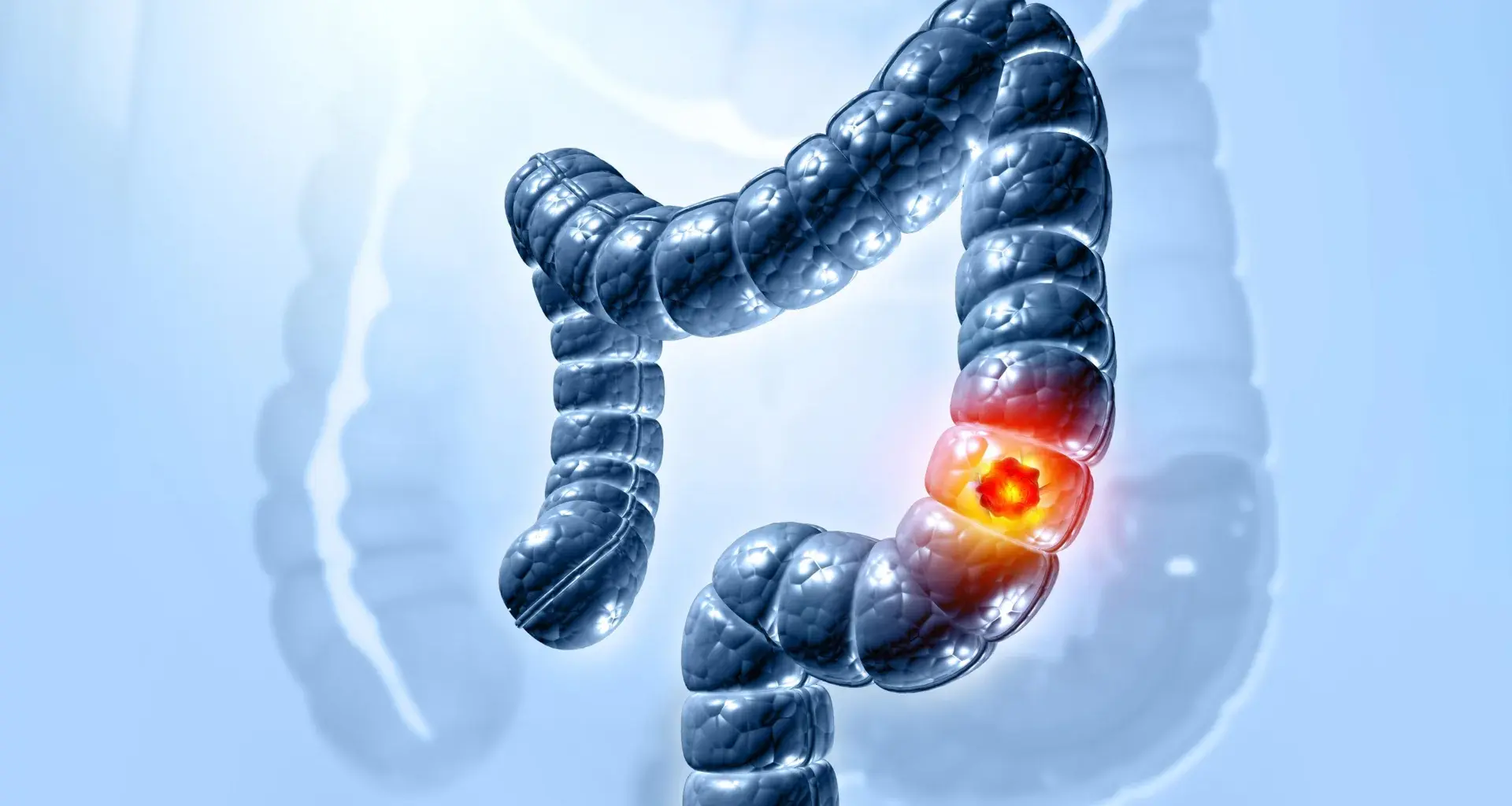Scientists finally solved how a common gut bacterium triggers colon cancer