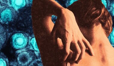 Millennial Women Should Beware Shingles