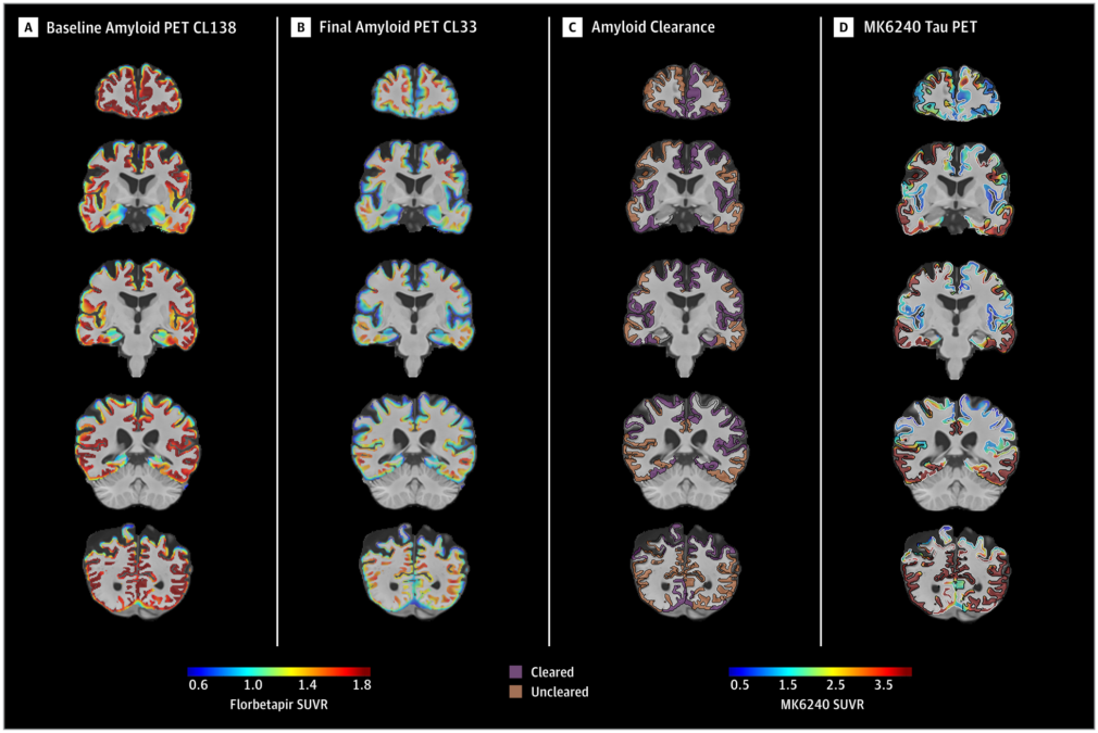 Rare Brain Autopsy Hints at Why Alzheimer's Drugs Are Failing