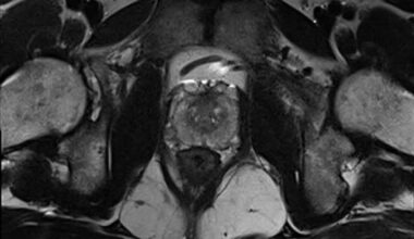 Prostate MRI image