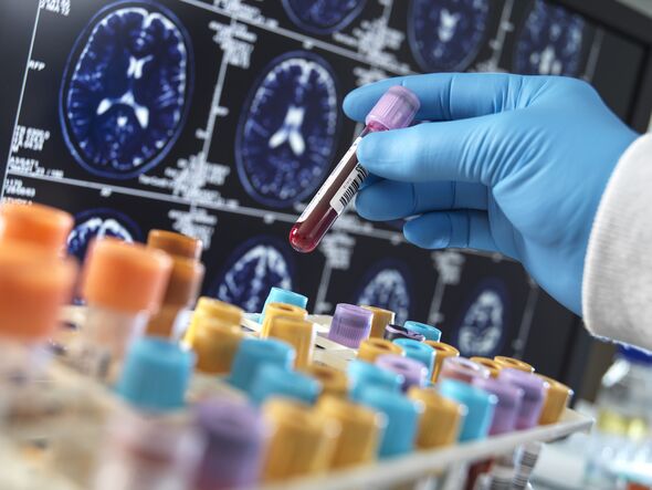 Scientist working with samples for dementia and alzheimers research Scientist working with samples for dementia and alzheimers research