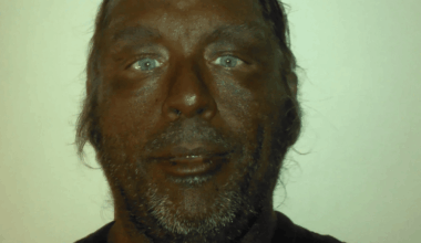 Man who's injected Melanotan II for years issues warning to people trying it