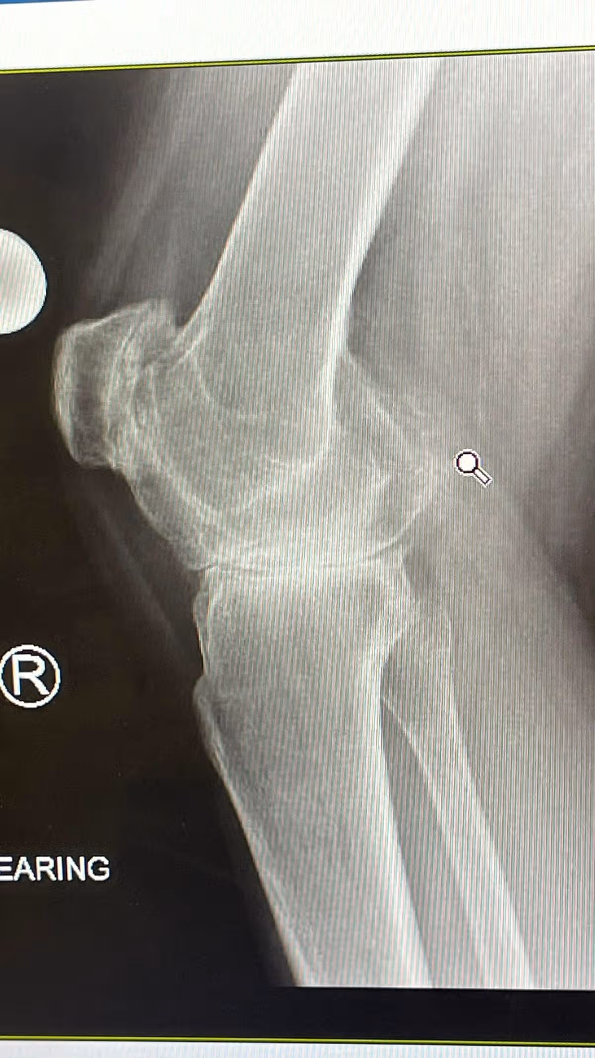 An X-ray of Phoebe's knee