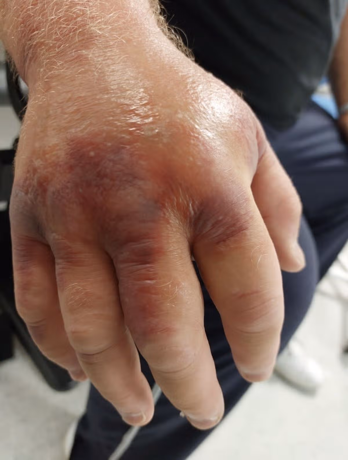 The start of the swelling