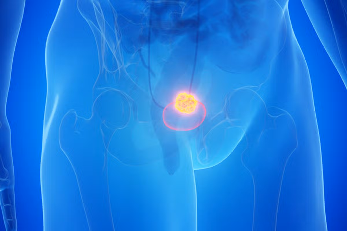 bladder cancer illustration