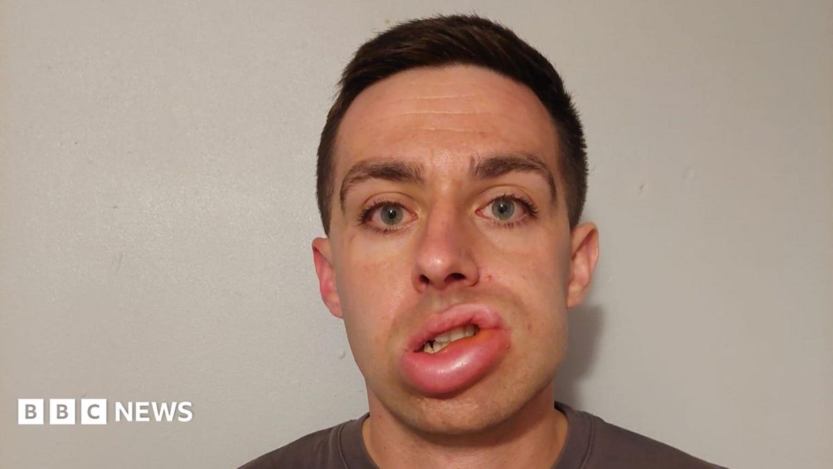 Jack Cope is standing in front of a white wall. He has short brown hair and is wearing a grey T-shirt. The left side of his face (the right when looking at the image) is swollen, including his lip.