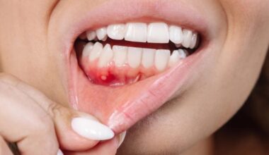 Gum Inflammation Ulcer Disease