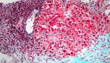 Microscope Image of Hepatocellular Carcinoma