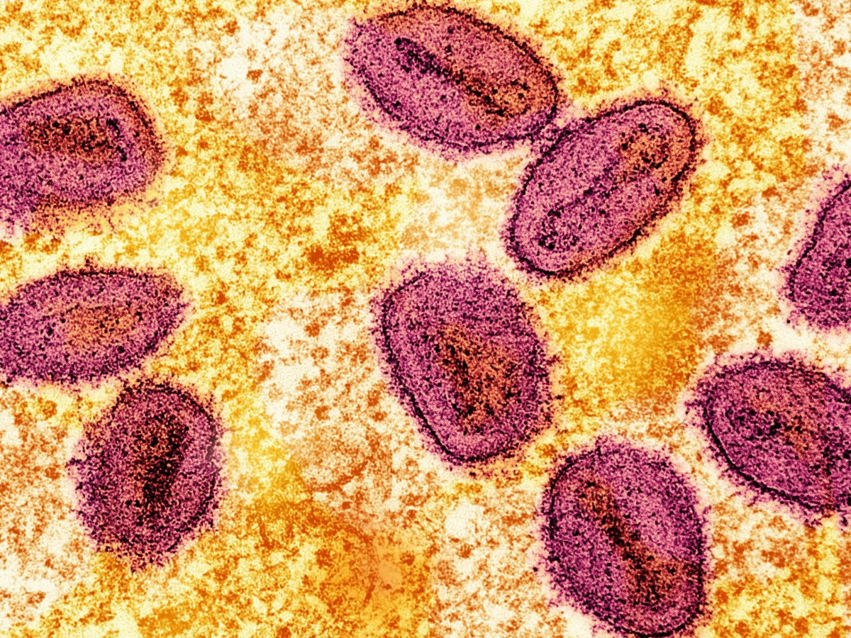 FILE PHOTO: An undated colorized transmission electron micrograph of mpox virus particles (pink) found within an infected cell (yellow), cultured in the laboratory, captured at the National Institute of Allergy and Infectious Diseases (NIAID) Integrated Research Facility (IRF) in Fort Detrick, Maryland. NIAID/Handout via REUTERS THIS IMAGE HAS BEEN SUPPLIED BY A THIRD PARTY. MANDATORY CREDIT/File Photo